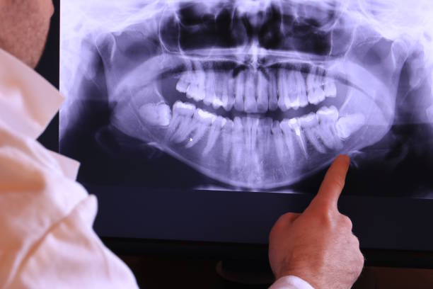 Best Emergency Tooth Extraction in Crooked Lake Park, FL